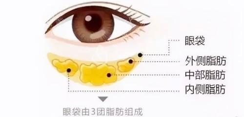 眼袋图示