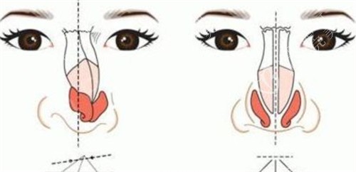 鼻梁矫正对比