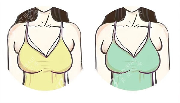 副乳图片