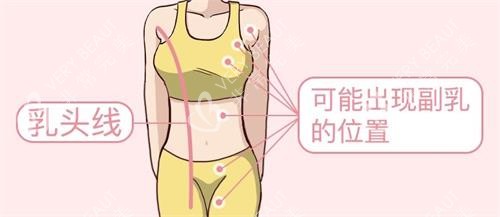 可能出现副乳的位置