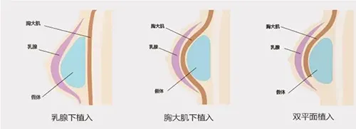 隆胸假体植入位置