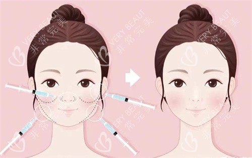 轻薄针注射打造幼态脸