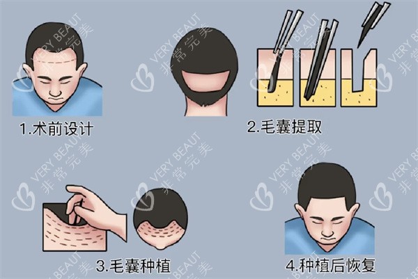 植发手术