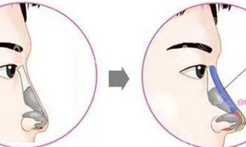 鼻小柱延长的手术示意图