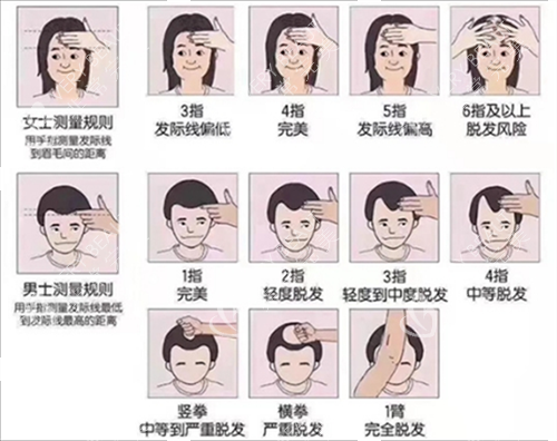 发际线测量规范