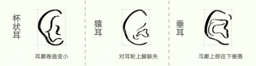 耳畸