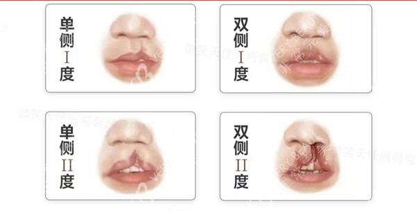 唇裂