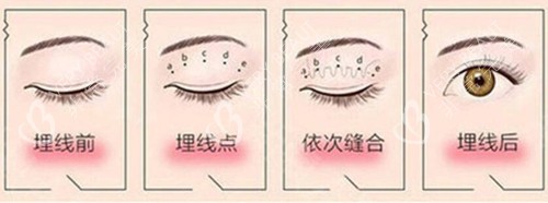 埋线双眼皮过程示意图片