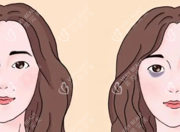 黑眼圈前后对比示意图