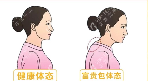 富贵包手术