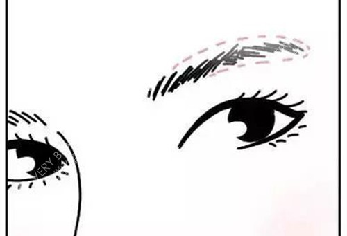 peek眉弓填充位置示意图
