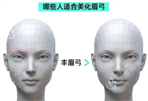 哪些人适合做眉弓整形