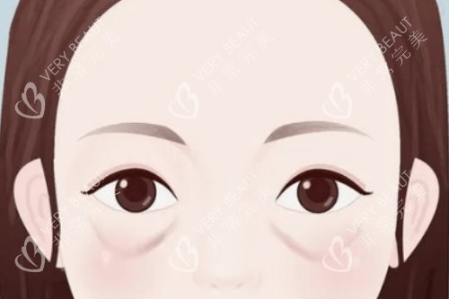 眼袋卡通展示图