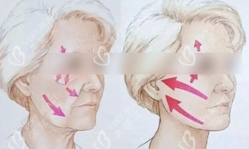 做拉皮手术前后动画图