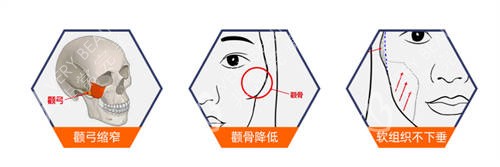 北京圣嘉新医疗美容医院张立天颧骨手术示意图