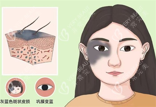太田痣的样子