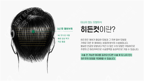 韩国moen植发医院技术