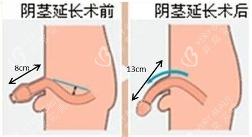 陰莖增長手術(shù)前后對比動畫圖