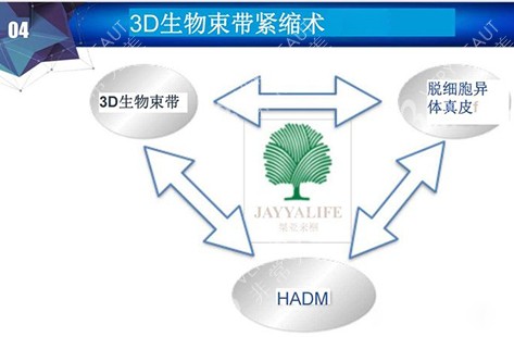 3d生物束帶緊縮術(shù)講解示意圖