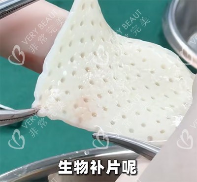生物補(bǔ)片改善增大增粗照片
