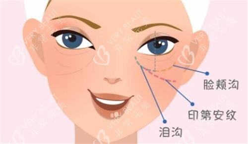 淚溝填充圖