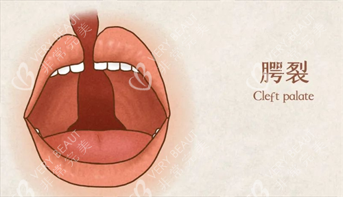 唇腭裂口内的动画展示