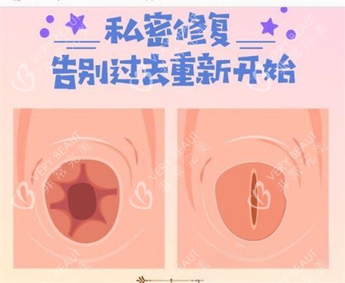 生物可吸收缝合技术前后对比图