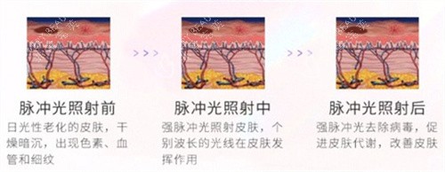 光子嫩肤对比