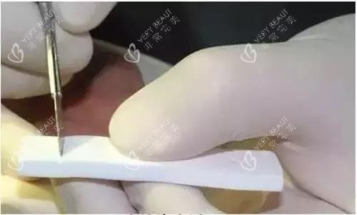 隆鼻手术雕刻中的膨体