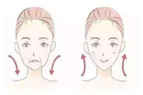 拉皮面部提升对比卡通示意图