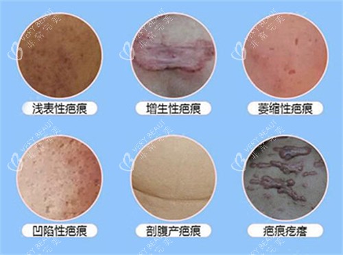常见的疤痕有哪些