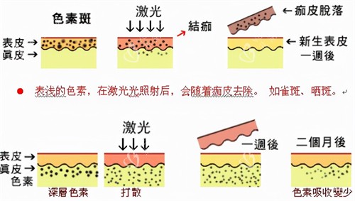 激光祛斑过程