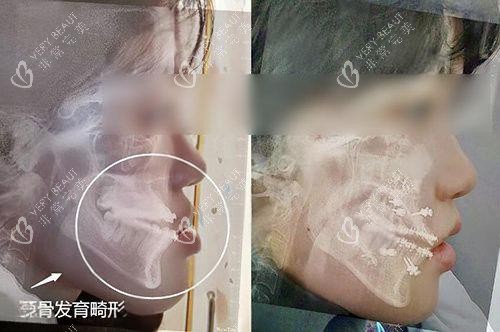 地包天正颌手术前后对比