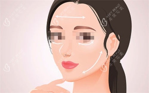 拉皮手术后面部提拉展示图