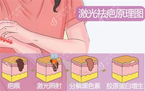 激光祛疤原理示图