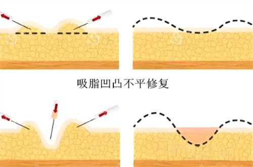 吸脂术后皮肤凹凸不平