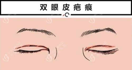 双眼皮疤痕修复动画图