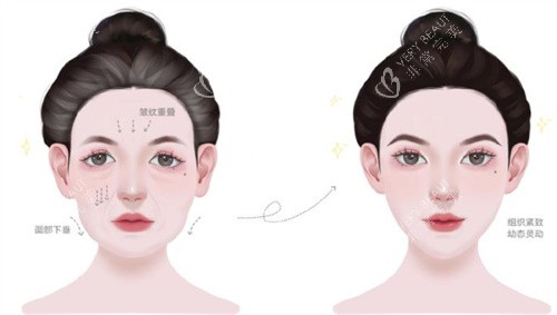 幼态脸前后紧致度对比