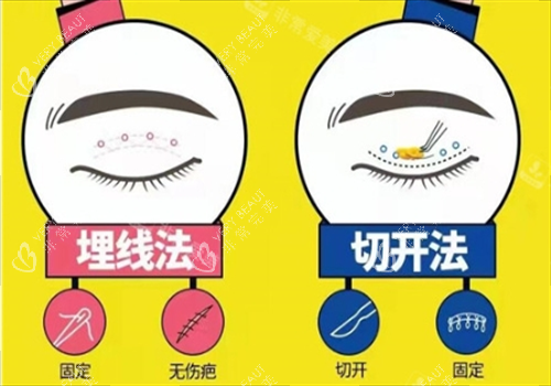 双眼皮埋线和切开对比图