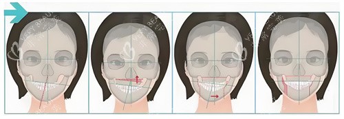 正颌手术手术步骤展示动画图
