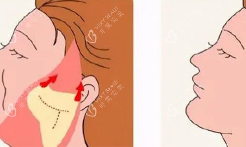 拉皮手术的术后对比图