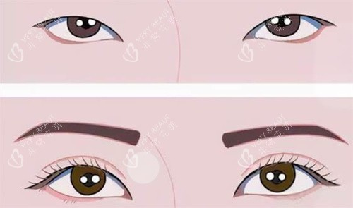双眼皮前后对比