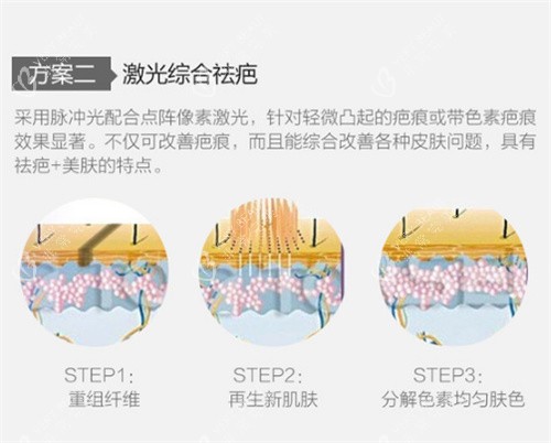 激光祛疤图示