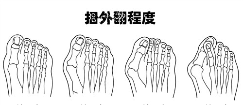 大脚骨外翻程度