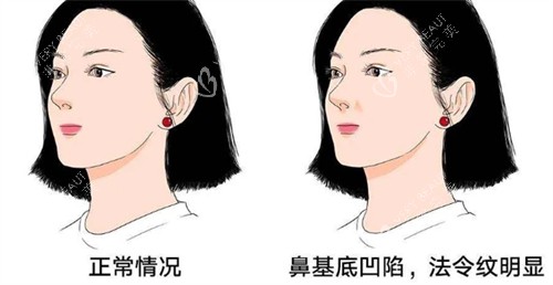 正常鼻基底和凹陷鼻基底