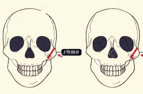 颧骨磨骨整形卡通示意图