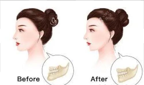 正颌手术后的成效图片