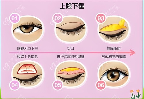 上睑下垂手术图示