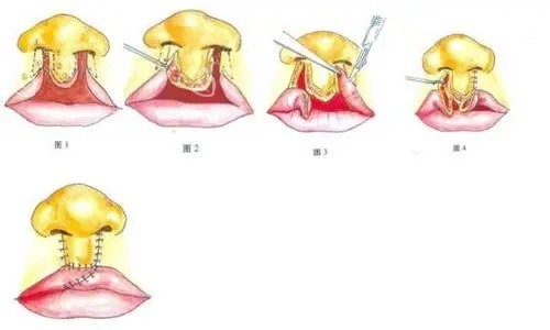 唇裂鼻修复图