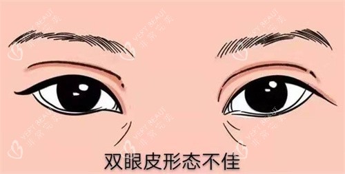 修复双眼皮